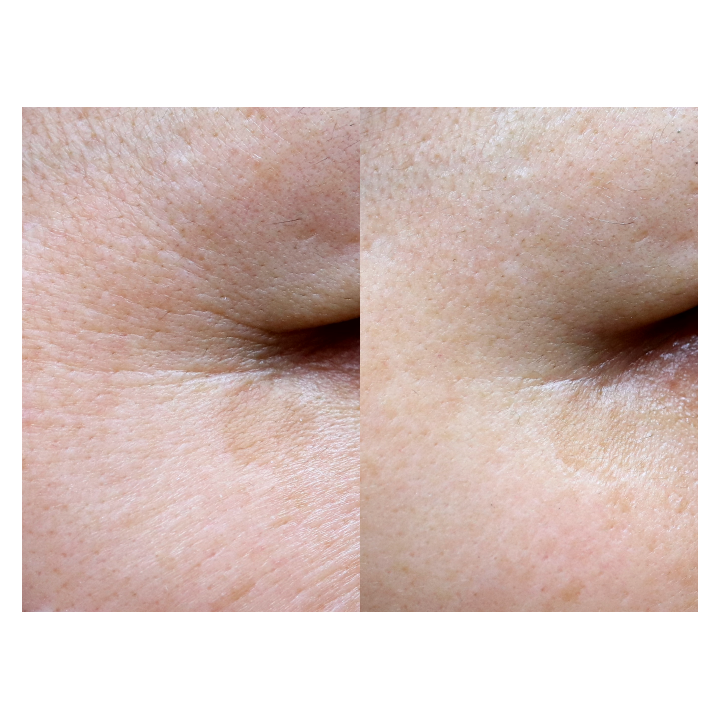 Gouri Kollagen Filler