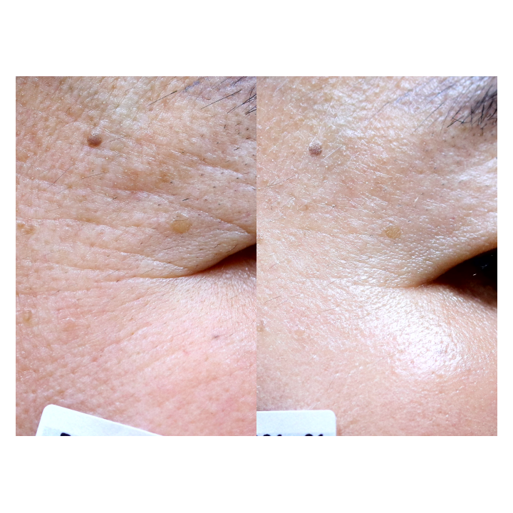 Gouri Kollagen Filler