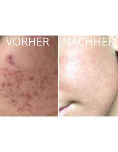 Dr. Pen Ultima A6 - Hautglättung mit Microneedling | jetzt kaufen
