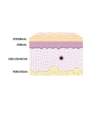 Hyaluron Spritze zur Faltenunterpriztung Dermal Filler mit Hyaluronsäure Volumenaufbau