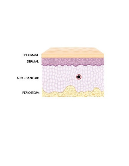 Hyaluron Spritze zur Faltenunterpriztung Dermal Filler mit Hyaluronsäure Volumenaufbau