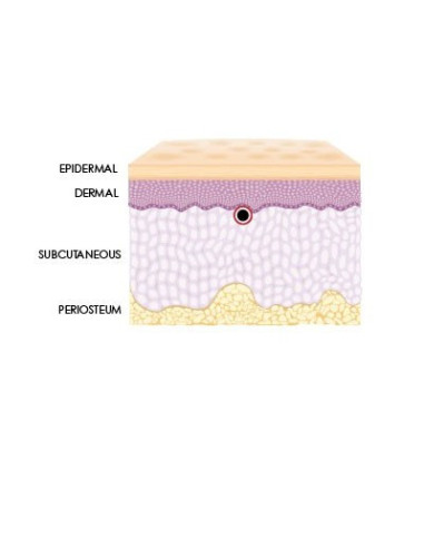Neue Hyaluronsäure Spritze zur Hydration und Auffrischung
