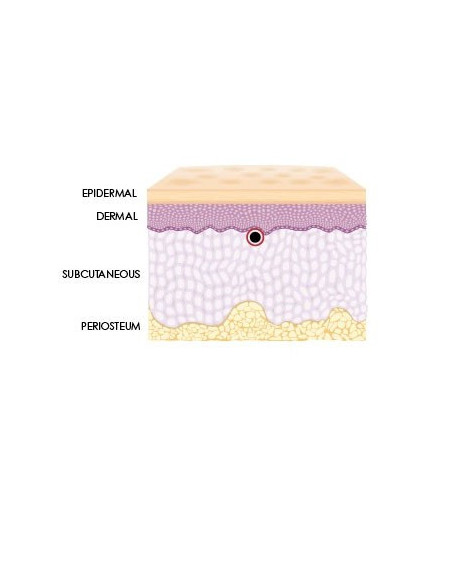 Neue Hyaluronsäure Spritze zur Hydration und Auffrischung