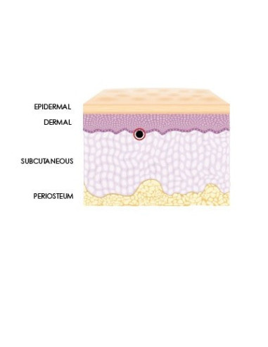 Neue Hyaluronsäure Spritze zur Nasen- und Kinn- Modellierung, Korrektur tiefer Falten