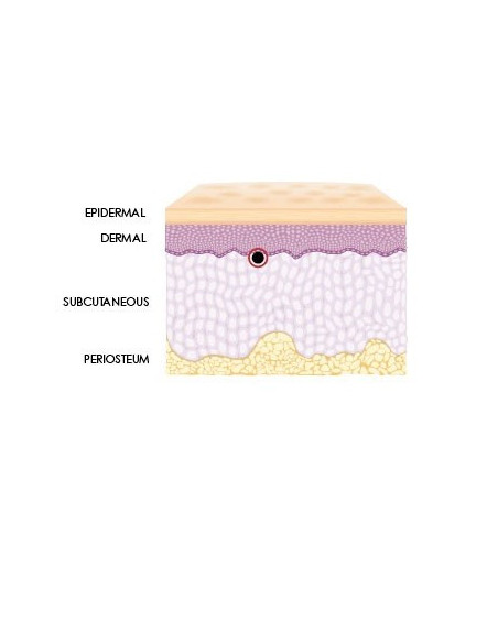 Neue Hyaluronsäure Spritze zur Nasen- und Kinn- Modellierung, Korrektur tiefer Falten