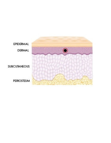 Neue Hyaluronsäure Spritze zur Korrektur leichter Falten