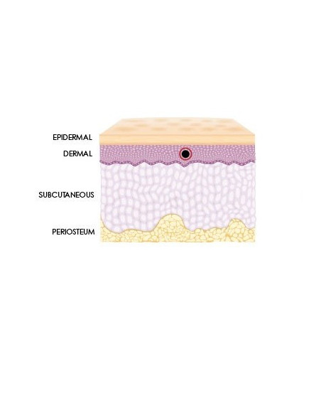 Neue Hyaluronsäure Spritze zur Korrektur leichter Falten