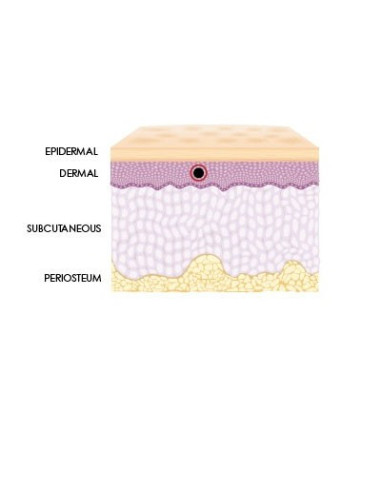 Neue Hyaluronsäure Spritze zur Lippenauffrischung und leichtes Volumen