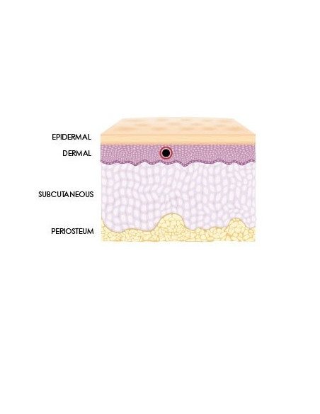 Neue Hyaluronsäure Spritze zur Lippenauffrischung und leichtes Volumen