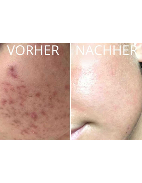 Dr. P Ultima M8 - Hautglättung mit Microneedling | jetzt kaufen