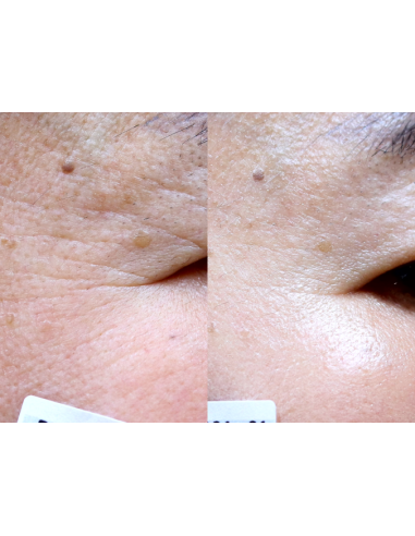 Gouri Kollagen Filler