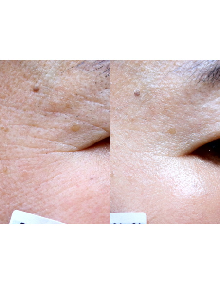 Gouri Kollagen Filler