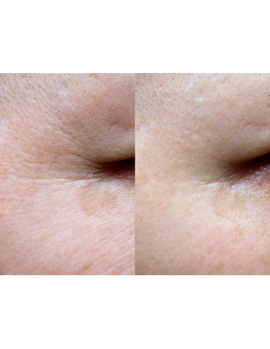 Gouri Kollagen Filler