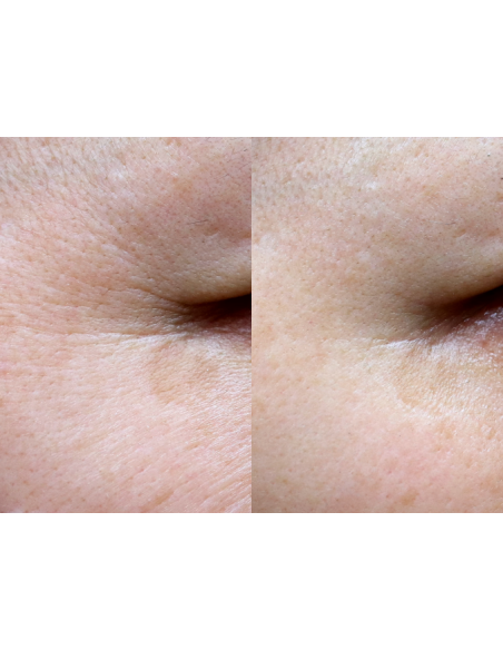 Gouri Kollagen Filler